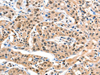 The image on the left is immunohistochemistry of paraffin-embedded Human liver cancer tissue using the antibody Antibody) at dilution 1/20, on the right is treated with fusion protein. (Original magnification: ×200)Rabbit anti-Human DDX4 Polyclonal Antibody