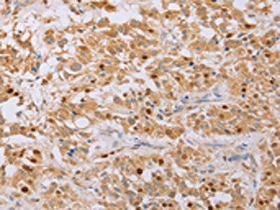 The image on the left is immunohistochemistry of paraffin-embedded Human thyroid cancer tissue using MCM5 Antibody(MCM5 Antibody) at dilution 1/40, on the right is treated with fusion protein. (Original magnification: ×200)