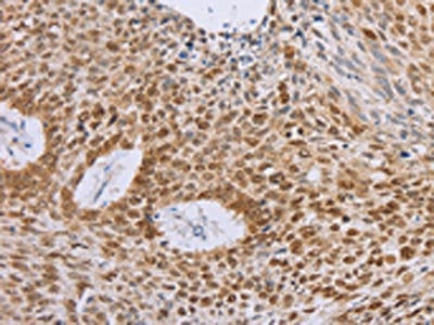 The image on the left is immunohistochemistry of paraffin-embedded Human lung cancer tissue using the antibody Antibody) at dilution 1/40, on the right is treated with fusion protein. (Original magnification: ×200)