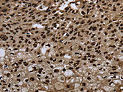 The image on the left is immunohistochemistry of paraffin-embedded Human esophagus cancer tissue using the antibody Antibody) at dilution 1/20, on the right is treated with synthetic peptide. (Original magnification: ×200)Rabbit anti-Human ANP32E Polyclonal Antibody