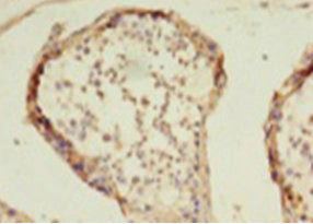 Immunohistochemistry of paraffin-embedded human colon cancer using HDAC1 Antibody at dilution of 1: 100Rabbit anti-Human HDAC1 Polyclonal Antibody