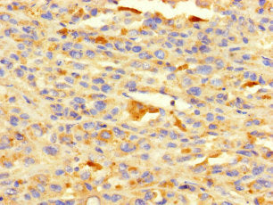 Immunohistochemistry of paraffin-embedded human melanoma using HDAC1 Antibody at dilution of 1:100Rabbit anti-Human HDAC1 Polyclonal Antibody