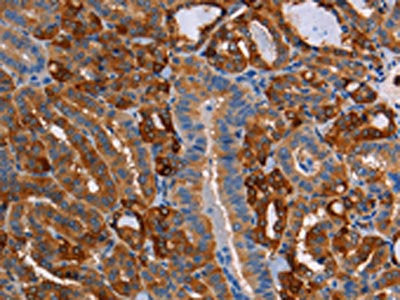 The image on the left is immunohistochemistry of paraffin-embedded Human thyroid cancer tissue using CRYAB Antibody(CRYAB Antibody) at dilution 1/25, on the right is treated with fusion protein. (Original magnification: ×200)Rabbit anti-Human CRYAB Polyclonal Antibody