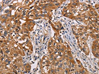 The image on the left is immunohistochemistry of paraffin-embedded Human esophagus cancer tissue using the antibody Antibody) at dilution 1/25, on the right is treated with fusion protein. (Original magnification: ×200)Rabbit anti-Human CRYAB Polyclonal Antibody