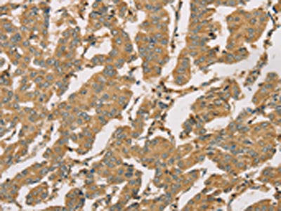 The image on the left is immunohistochemistry of paraffin-embedded Human breast cancer tissue using DMRT3 Antibody(DMRT3 Antibody) at dilution 1/50, on the right is treated with fusion protein. (Original magnification: ×200)Rabbit anti-Human DMRT3 Polyclonal Antibody