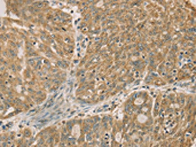 The image on the left is immunohistochemistry of paraffin-embedded Human ovarian cancer tissue using the antibody Antibody) at dilution 1/50, on the right is treated with fusion protein. (Original magnification: ×200)Rabbit anti-Human DMRT3 Polyclonal Antibody