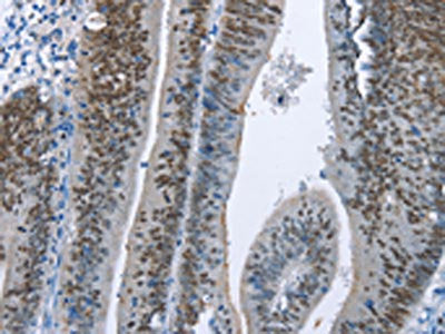 The image on the left is immunohistochemistry of paraffin-embedded Human colon cancer tissue using MCM6 Antibody(MCM6 Antibody) at dilution 1/60, on the right is treated with fusion protein. (Original magnification: ×200)