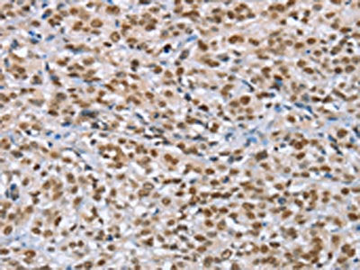 The image on the left is immunohistochemistry of paraffin-embedded Human esophagus cancer tissue using the antibody Antibody) at dilution 1/60, on the right is treated with fusion protein. (Original magnification: ×200)