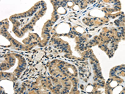 The image on the left is immunohistochemistry of paraffin-embedded Human thyroid cancer tissue using WDR36 Antibody(WDR36 Antibody) at dilution 1/35, on the right is treated with synthetic peptide. (Original magnification: ×200)Rabbit anti-Human WDR36 Polyclonal Antibody