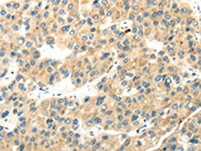 The image on the left is immunohistochemistry of paraffin-embedded Human liver cancer tissue using the antibody Antibody) at dilution 1/35, on the right is treated with synthetic peptide. (Original magnification: ×200)Rabbit anti-Human WDR36 Polyclonal Antibody