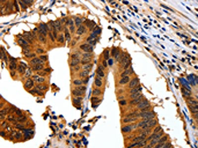 The image on the left is immunohistochemistry of paraffin-embedded Human colon cancer tissue using YWHAB Antibody(YWHAB Antibody) at dilution 1/30, on the right is treated with synthetic peptide. (Original magnification: ×200)Rabbit anti-Human YWHAB Polyclonal Antibody