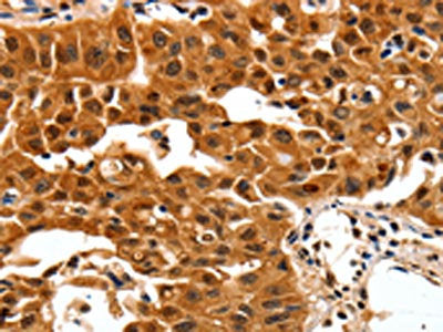 The image on the left is immunohistochemistry of paraffin-embedded Human lung cancer tissue using the antibody Antibody) at dilution 1/30, on the right is treated with synthetic peptide. (Original magnification: ×200)Rabbit anti-Human YWHAB Polyclonal Antibody