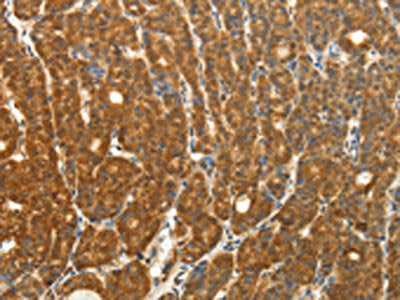 The image on the left is immunohistochemistry of paraffin-embedded Human thyroid cancer tissue using PTCH1 Antibody(PTCH1 Antibody) at dilution 1/50, on the right is treated with fusion protein. (Original magnification: ×200)Rabbit anti-Human PTCH1 Polyclonal Antibody