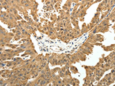 The image on the left is immunohistochemistry of paraffin-embedded Human ovarian cancer tissue using the antibody Antibody) at dilution 1/50, on the right is treated with fusion protein. (Original magnification: ×200)Rabbit anti-Human PTCH1 Polyclonal Antibody