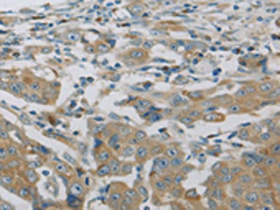 The image on the left is immunohistochemistry of paraffin-embedded Human breast cancer tissue using MAP2K6 Antibody(MAP2K6 Antibody) at dilution 1/30, on the right is treated with fusion protein. (Original magnification: ×200)