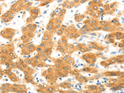 The image on the left is immunohistochemistry of paraffin-embedded Human liver cancer tissue using the antibody Antibody) at dilution 1/30, on the right is treated with fusion protein. (Original magnification: ×200)