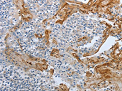 The image on the left is immunohistochemistry of paraffin-embedded Human tonsil tissue using BRAF Antibody(BRAF Antibody) at dilution 1/60, on the right is treated with synthetic peptide. (Original magnification: ×200)