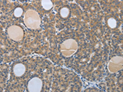 The image on the left is immunohistochemistry of paraffin-embedded Human thyroid cancer tissue using the antibody Antibody) at dilution 1/60, on the right is treated with synthetic peptide. (Original magnification: ×200)