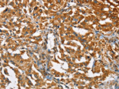 The image on the left is immunohistochemistry of paraffin-embedded Human thyroid cancer tissue using BCAP31 Antibody(BCAP31 Antibody) at dilution 1/30, on the right is treated with fusion protein. (Original magnification: ×200)