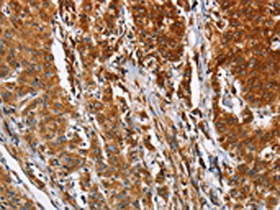 The image on the left is immunohistochemistry of paraffin-embedded Human gastic cancer tissue using the antibody Antibody) at dilution 1/30, on the right is treated with fusion protein. (Original magnification: ×200)