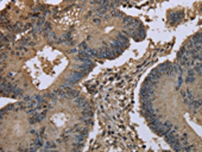 The image on the left is immunohistochemistry of paraffin-embedded Human colon cancer tissue using UBB Antibody(UBB Antibody) at dilution 1/20, on the right is treated with fusion protein. (Original magnification: ×200)Rabbit anti-Human UBB Polyclonal Antibody