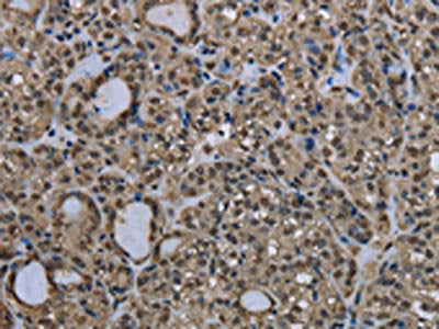 The image on the left is immunohistochemistry of paraffin-embedded Human thyroid cancer tissue using the antibody Antibody) at dilution 1/20, on the right is treated with fusion protein. (Original magnification: ×200)Rabbit anti-Human UBB Polyclonal Antibody