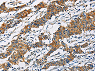 The image on the left is immunohistochemistry of paraffin-embedded Human gastic cancer tissue using the antibody Antibody) at dilution 1/40, on the right is treated with fusion protein. (Original magnification: ×200)Rabbit anti-Human PIP4K2A Polyclonal Antibody
