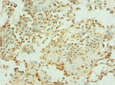 Immunohistochemistry of paraffin-embedded human breast cancer using the antibody at dilution of 1: 100Rabbit anti-Human TEP1 Polyclonal Antibody