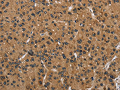 The image on the left is immunohistochemistry of paraffin-embedded Human liver cancer tissue using DNAJA1 Antibody(DNAJA1 Antibody) at dilution 1/30, on the right is treated with fusion protein. (Original magnification: ×200)Rabbit anti-Human DNAJA1 Polyclonal Antibody