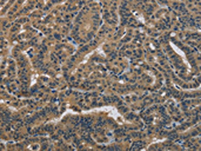 The image on the left is immunohistochemistry of paraffin-embedded Human thyroid cancer tissue using the antibody Antibody) at dilution 1/30, on the right is treated with fusion protein. (Original magnification: ×200)Rabbit anti-Human DNAJA1 Polyclonal Antibody
