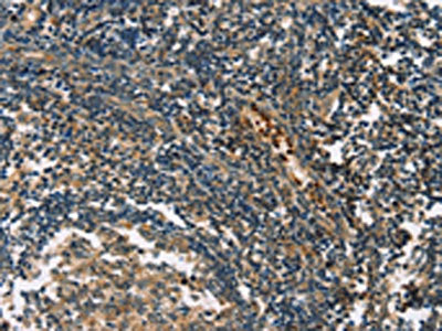 The image on the left is immunohistochemistry of paraffin-embedded Human tonsil tissue using GPR182 Antibody(GPR182 Antibody) at dilution 1/30, on the right is treated with synthetic peptide. (Original magnification: ×200)Rabbit anti-Human GPR182 Polyclonal Antibody