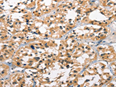 The image on the left is immunohistochemistry of paraffin-embedded Human thyroid cancer tissue using the antibody Antibody) at dilution 1/30, on the right is treated with synthetic peptide. (Original magnification: ×200)Rabbit anti-Human GPR182 Polyclonal Antibody