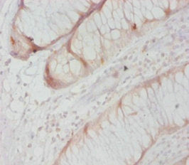 Immunohistochemistry of paraffin-embedded human colon cancer using CASP8 Antibody at dilution of 1:20