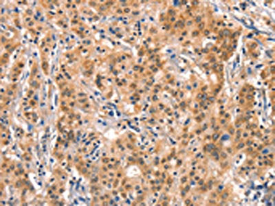 The image on the left is immunohistochemistry of paraffin-embedded Human gastric cancer tissue using AIMP1 Antibody(AIMP1 Antibody) at dilution 1/40, on the right is treated with synthetic peptide. (Original magnification: ×200)Rabbit anti-Human AIMP1 Polyclonal Antibody