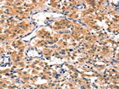 The image on the left is immunohistochemistry of paraffin-embedded Human thyroid cancer tissue using the antibody Antibody) at dilution 1/40, on the right is treated with synthetic peptide. (Original magnification: ×200)Rabbit anti-Human AIMP1 Polyclonal Antibody