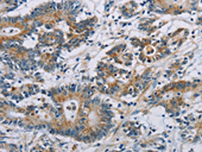 The image on the left is immunohistochemistry of paraffin-embedded Human colon cancer tissue using CSNK1E Antibody(CSNK1E Antibody) at dilution 1/60, on the right is treated with fusion protein. (Original magnification: ×200)Rabbit anti-Human CSNK1E Polyclonal Antibody