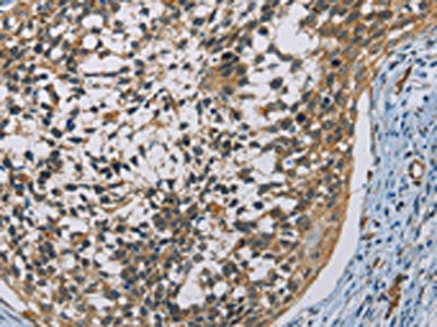 The image on the left is immunohistochemistry of paraffin-embedded Human cervical cancer tissue using the antibody Antibody) at dilution 1/60, on the right is treated with fusion protein. (Original magnification: ×200)Rabbit anti-Human CSNK1E Polyclonal Antibody