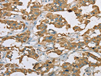 The image on the left is immunohistochemistry of paraffin-embedded Human thyroid cancer tissue using EHHADH Antibody(EHHADH Antibody) at dilution 1/20, on the right is treated with fusion protein. (Original magnification: ×200)Rabbit anti-Human EHHADH Polyclonal Antibody