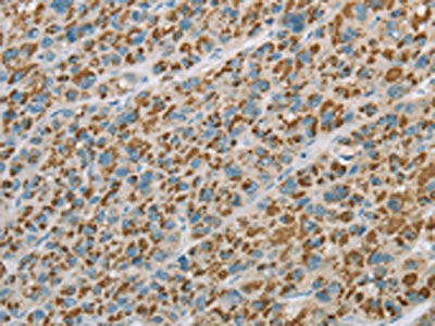 The image on the left is immunohistochemistry of paraffin-embedded Human liver cancer tissue using the antibody Antibody) at dilution 1/20, on the right is treated with fusion protein. (Original magnification: ×200)Rabbit anti-Human EHHADH Polyclonal Antibody