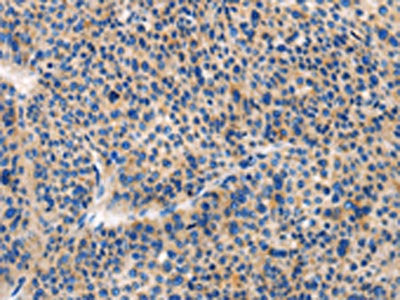 The image on the left is immunohistochemistry of paraffin-embedded Human liver cancer tissue using HCK Antibody(HCK Antibody) at dilution 1/20, on the right is treated with fusion protein. (Original magnification: ×200)Rabbit anti-Human HCK Polyclonal Antibody