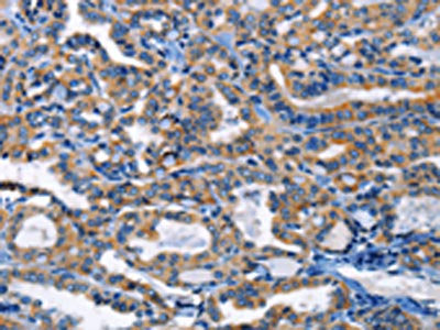 The image on the left is immunohistochemistry of paraffin-embedded Human thyroid cancer tissue using the antibody Antibody) at dilution 1/20, on the right is treated with fusion protein. (Original magnification: ×200)Rabbit anti-Human HCK Polyclonal Antibody