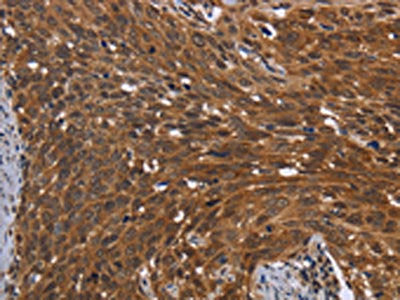 The image on the left is immunohistochemistry of paraffin-embedded Human cervical cancer tissue using FHIT Antibody(FHIT Antibody) at dilution 1/30, on the right is treated with fusion protein. (Original magnification: ×200)Rabbit anti-Human FHIT Polyclonal Antibody