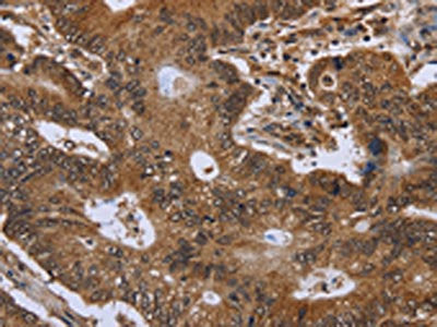 The image on the left is immunohistochemistry of paraffin-embedded Human colon cancer tissue using the antibody Antibody) at dilution 1/30, on the right is treated with fusion protein. (Original magnification: ×200)Rabbit anti-Human FHIT Polyclonal Antibody
