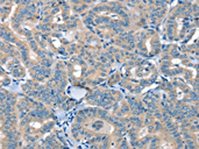 The image on the left is immunohistochemistry of paraffin-embedded Human thyroid cancer tissue using the antibody Antibody) at dilution 1/20, on the right is treated with synthetic peptide. (Original magnification: ×200)Rabbit anti-Human SEPN1 Polyclonal Antibody