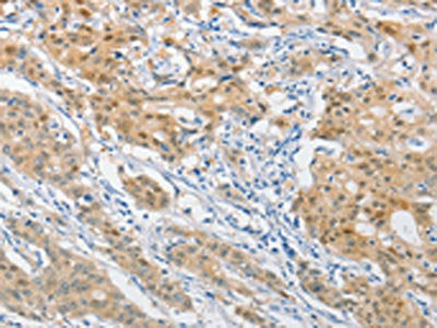 The image on the left is immunohistochemistry of paraffin-embedded Human gastric cancer tissue using DNAJB1 Antibody(DNAJB1 Antibody) at dilution 1/40, on the right is treated with fusion protein. (Original magnification: ×200)Rabbit anti-Human DNAJB1 Polyclonal Antibody