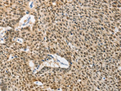 The image on the left is immunohistochemistry of paraffin-embedded Human lung cancer tissue using the antibody Antibody) at dilution 1/40, on the right is treated with fusion protein. (Original magnification: ×200)Rabbit anti-Human DNAJB1 Polyclonal Antibody