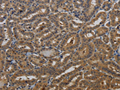 The image on the left is immunohistochemistry of paraffin-embedded Human thyroid cancer tissue using KCNK17 Antibody(KCNK17 Antibody) at dilution 1/50, on the right is treated with fusion protein. (Original magnification: ×200)