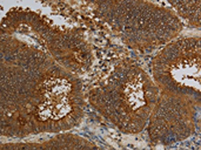 The image on the left is immunohistochemistry of paraffin-embedded Human colon cancer tissue using the antibody Antibody) at dilution 1/50, on the right is treated with fusion protein. (Original magnification: ×200)