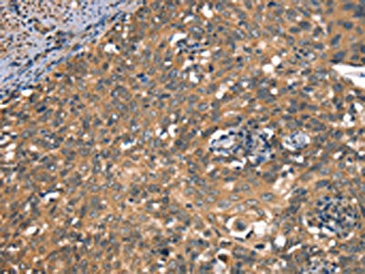 The image on the left is immunohistochemistry of paraffin-embedded Human cervical cancer tissue using the antibody Antibody) at dilution 1/50, on the right is treated with synthetic peptide. (Original magnification: ×200)Rabbit anti-Human DAAM1 Polyclonal Antibody