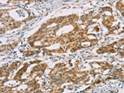 The image on the left is immunohistochemistry of paraffin-embedded Human gastic cancer tissue using the antibody Antibody) at dilution 1/25, on the right is treated with fusion protein. (Original magnification: ×200)Rabbit anti-Human DMRT3 Polyclonal Antibody